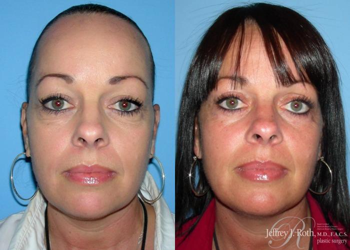 Before & After Eyelid Surgery Case 131 View #1 View in Las Vegas and Henderson, NV