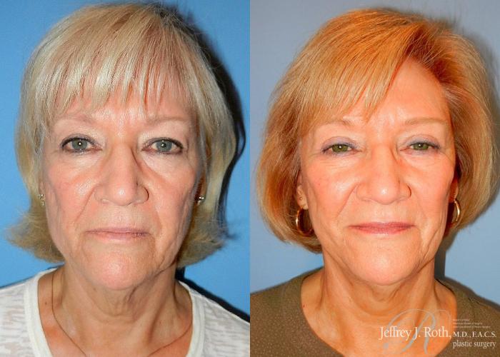 Before & After Eyelid Surgery Case 136 View #1 View in Las Vegas and Henderson, NV