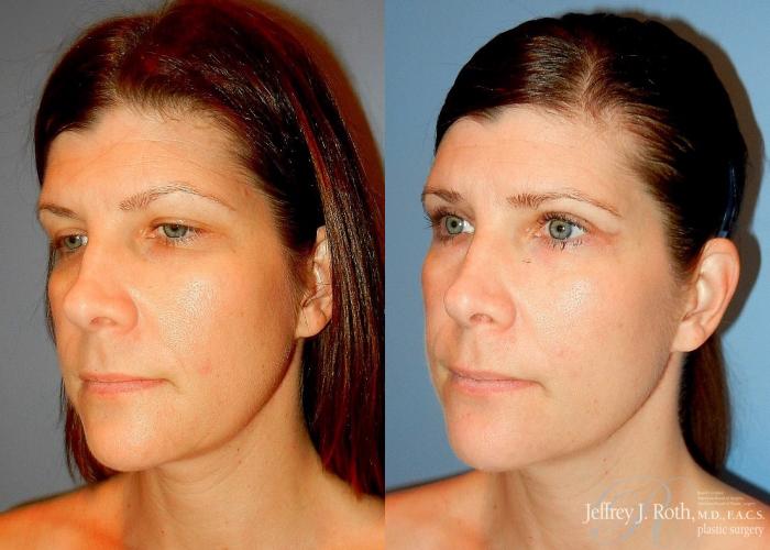 Before & After Eyelid Surgery Case 138 View #1 View in Las Vegas and Henderson, NV
