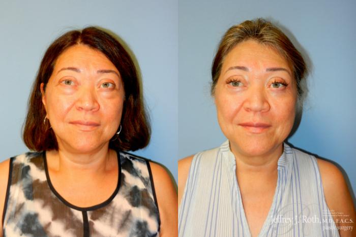 Before & After Eyelid Surgery Case 277 Front View in Las Vegas and Henderson, NV