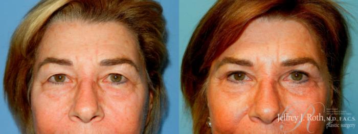 Before & After Eyelid Surgery Case 312 Front View in Las Vegas and Henderson, NV