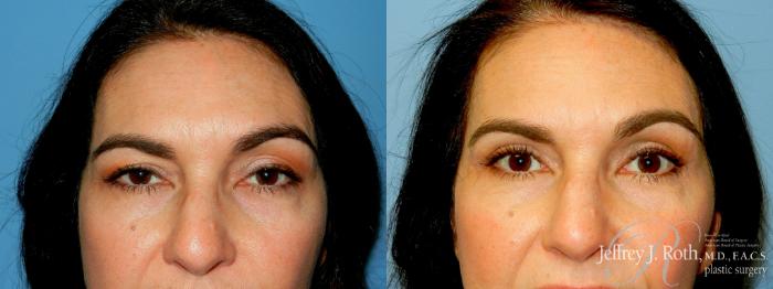Before & After Eyelid Surgery Case 316 Front View in Las Vegas and Henderson, NV