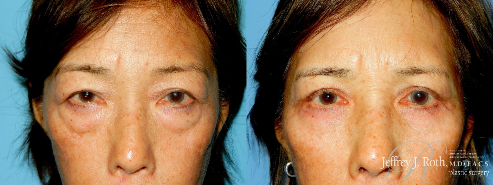 Before & After Eyelid Surgery Case 334 Front View in Las Vegas and Henderson, NV