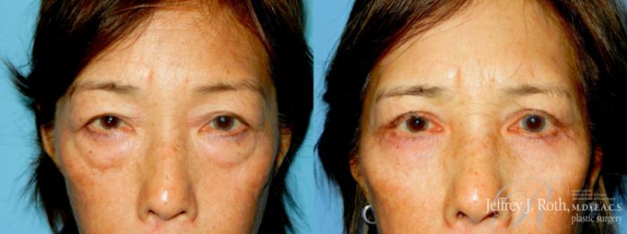 Before & After Eyelid Surgery Case 334 Front View in Las Vegas and Henderson, NV