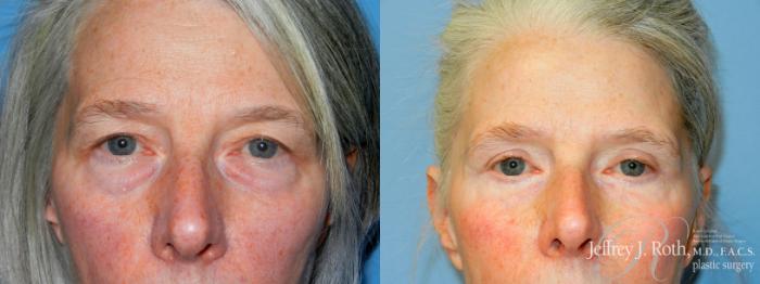 Before & After Eyelid Surgery Case 338 Front View in Las Vegas and Henderson, NV