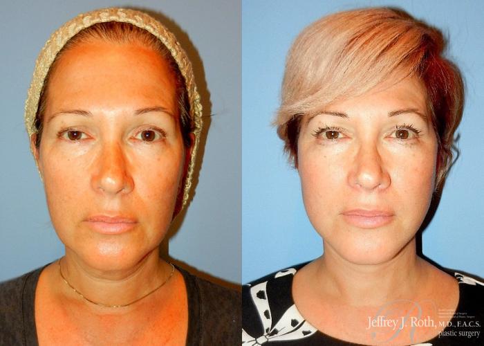 Before & After Facelift & Neck Lift Case 139 View #1 View in Las Vegas and Henderson, NV