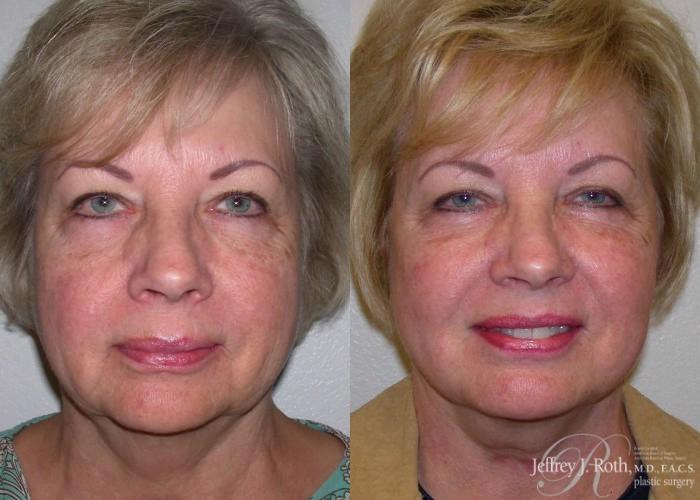 Before & After Facelift & Neck Lift Case 140 View #1 View in Las Vegas and Henderson, NV