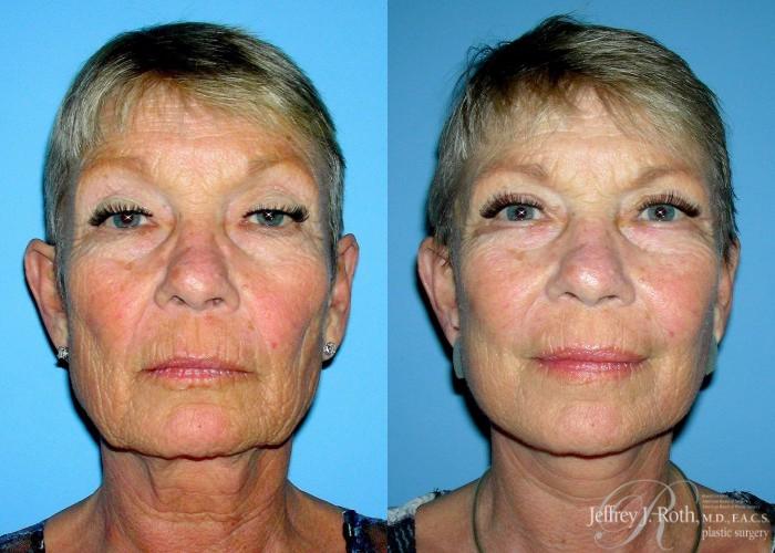 Before & After Facelift & Neck Lift Case 141 View #1 View in Las Vegas and Henderson, NV