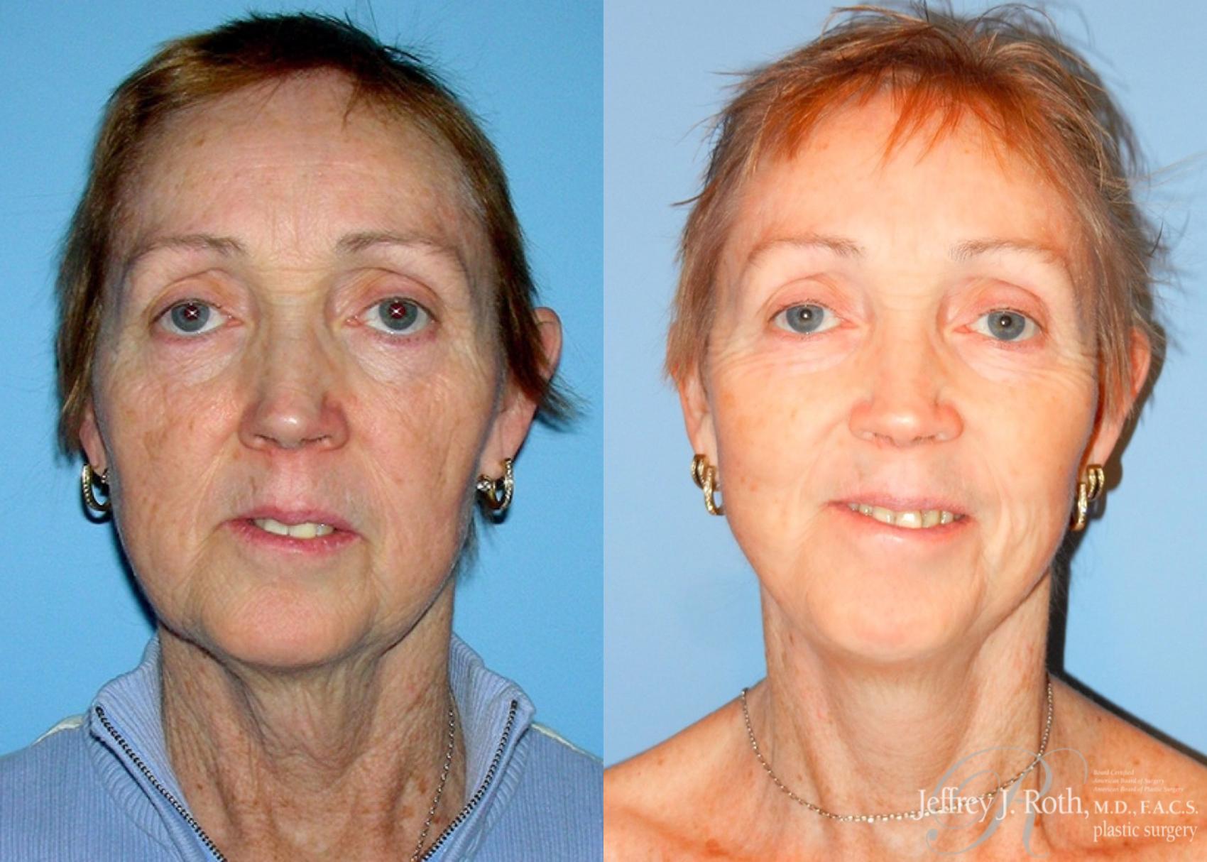 Before & After Facelift & Neck Lift Case 142 View #1 View in Las Vegas and Henderson, NV