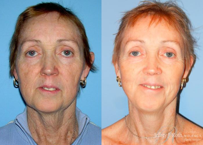 Before & After Facelift & Neck Lift Case 142 View #1 View in Las Vegas, NV