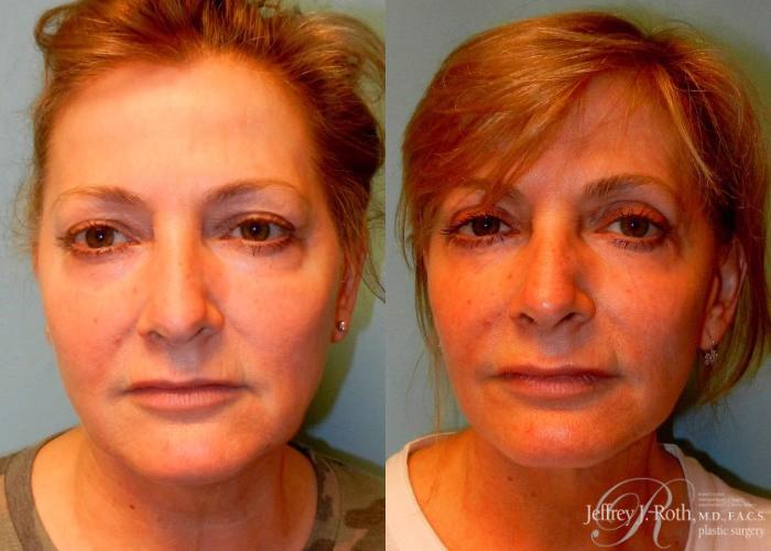 Before & After Eyelid Surgery Case 145 View #1 View in Las Vegas and Henderson, NV