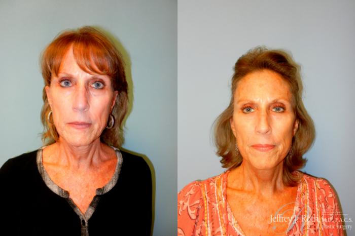 Before & After Facelift & Neck Lift Case 227 Front View in Las Vegas and Henderson, NV