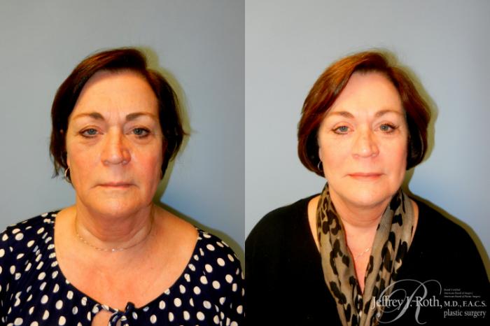Before & After Facelift & Neck Lift Case 238 Front View in Las Vegas, NV