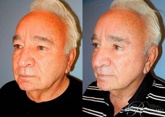 Before & After Eyelid Surgery Case 170 View #1 View in Las Vegas and Henderson, NV