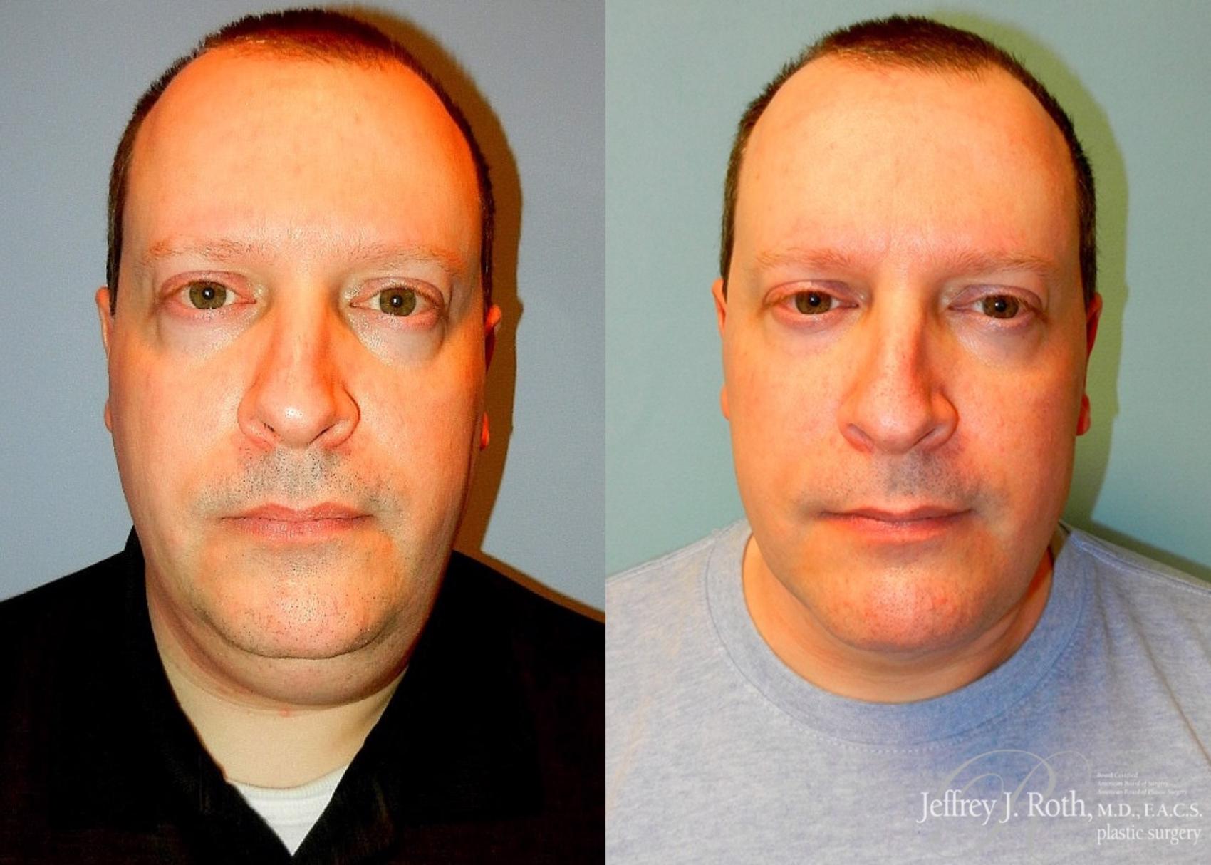 Before & After Facelift & Neck Lift for Men Case 171 View #1 View in Las Vegas and Henderson, NV