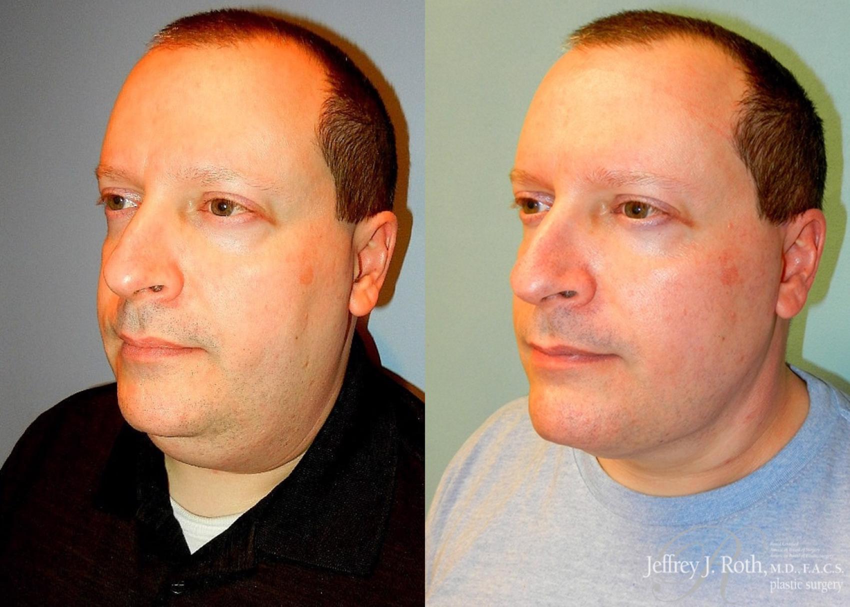 Before & After Facelift & Neck Lift for Men Case 171 View #2 View in Las Vegas and Henderson, NV
