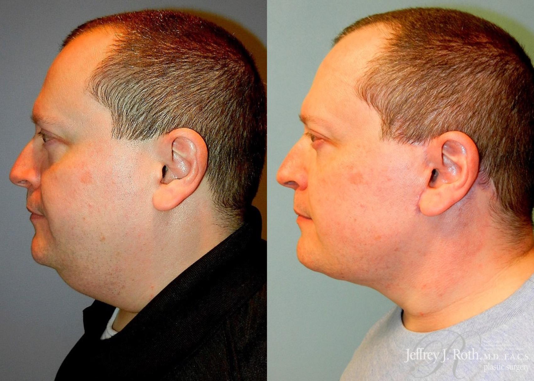 Before & After Facelift & Neck Lift for Men Case 171 View #3 View in Las Vegas and Henderson, NV