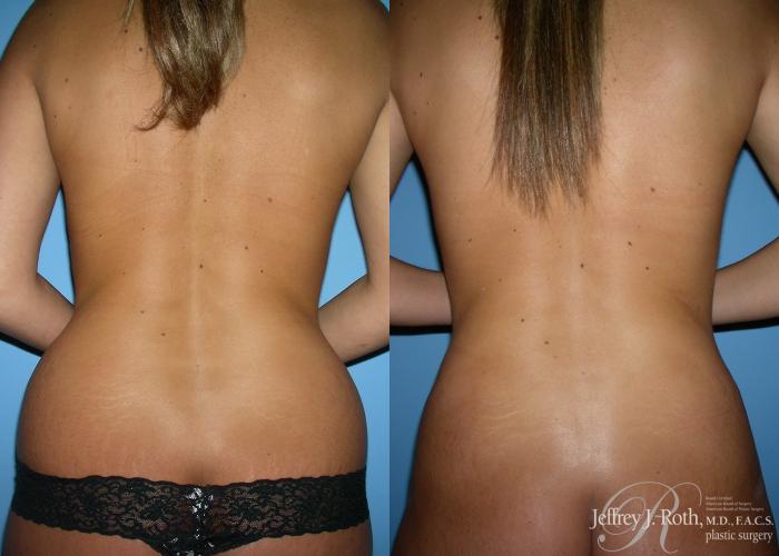 Before & After Liposuction Case 11 View #1 View in Las Vegas and Henderson, NV