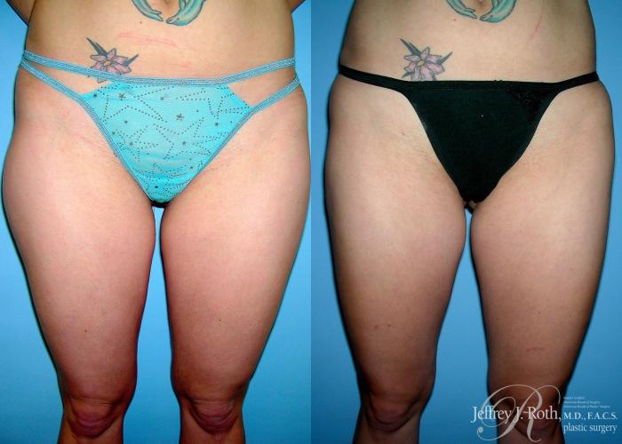 Before & After Liposuction Case 13 View #1 View in Las Vegas and Henderson, NV