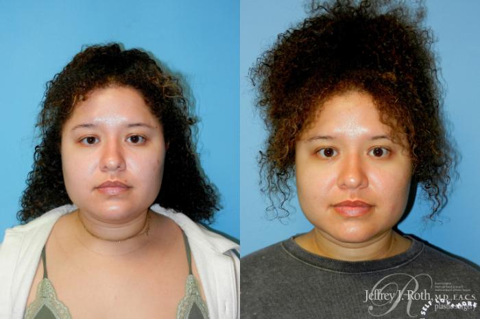 Before & After Liposuction Case 315 Front View in Las Vegas and Henderson, NV