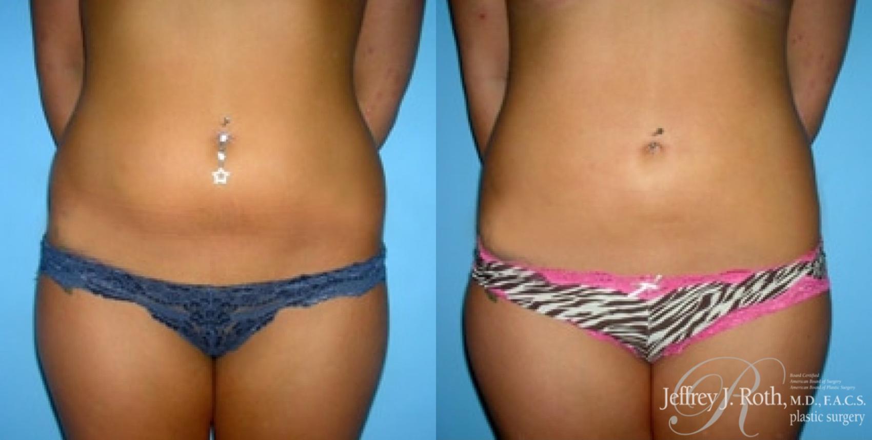 Before & After Liposuction Case 7 View #1 View in Las Vegas and Henderson, NV