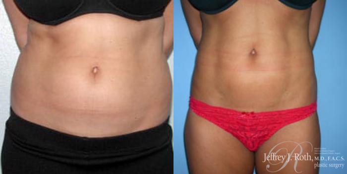 Before & After Liposuction Case 8 View #1 View in Las Vegas and Henderson, NV