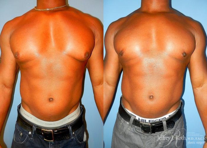Before & After Liposuction Case 176 View #1 View in Las Vegas and Henderson, NV