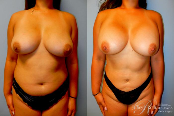 Before & After Mommy Makeover Case 307 Front View in Las Vegas and Henderson, NV