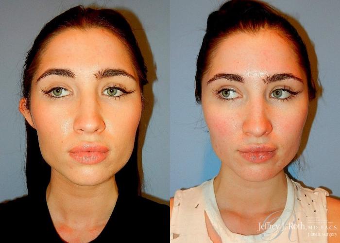 Before & After Otoplasty Case 113 View #1 View in Las Vegas and Henderson, NV