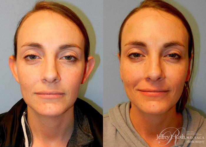 Before & After Otoplasty Case 114 View #1 View in Las Vegas and Henderson, NV