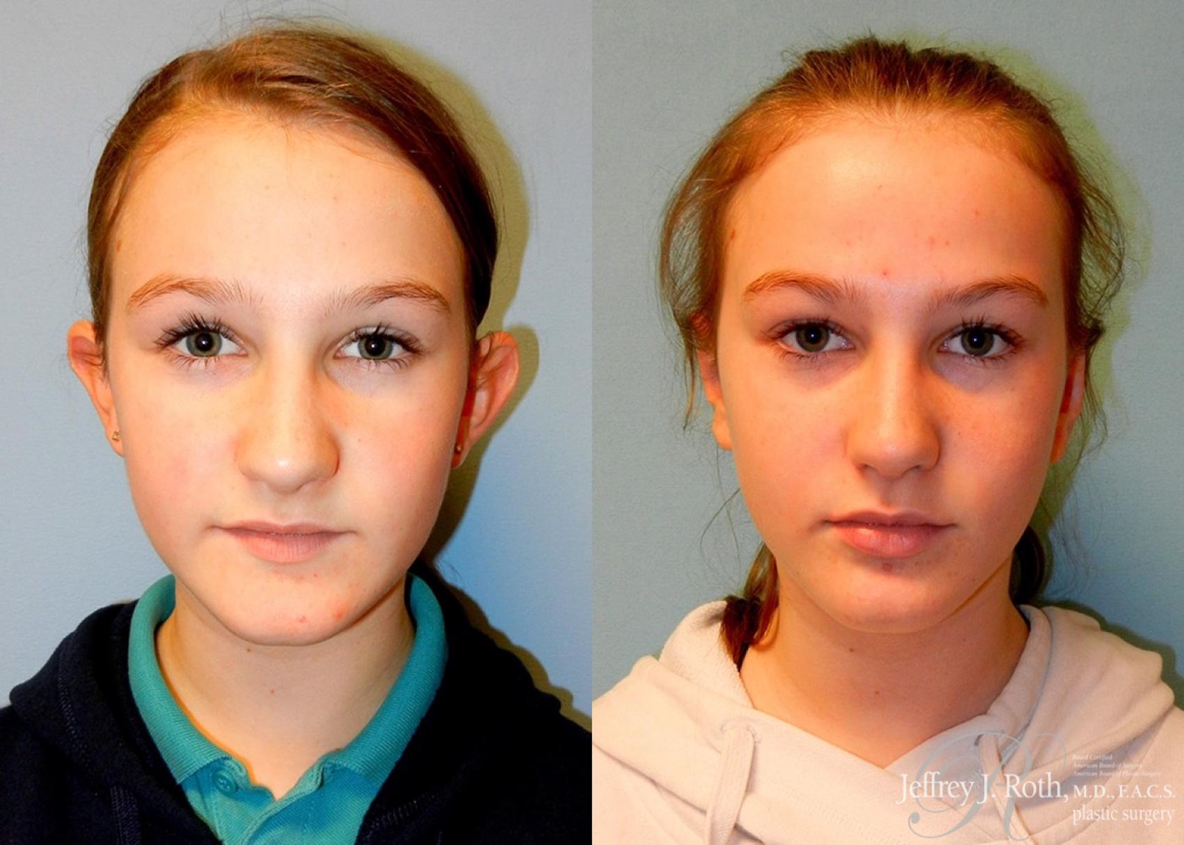Before & After Otoplasty Case 115 View #1 View in Las Vegas and Henderson, NV