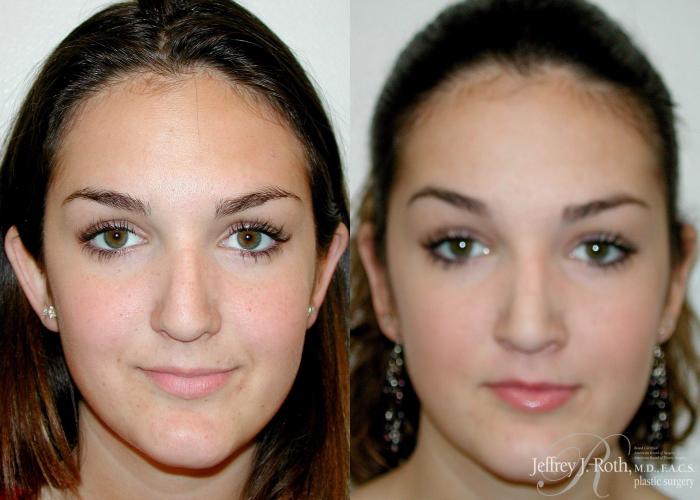 Before & After Otoplasty Case 116 View #1 View in Las Vegas and Henderson, NV