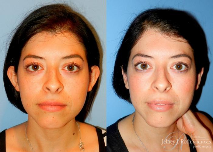 Before & After Otoplasty Case 117 Front View in Las Vegas and Henderson, NV