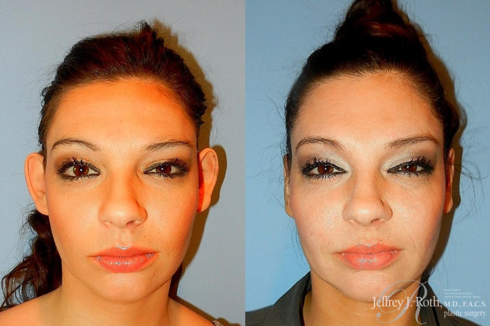 Before & After Otoplasty Case 299 Front View in Las Vegas and Henderson, NV