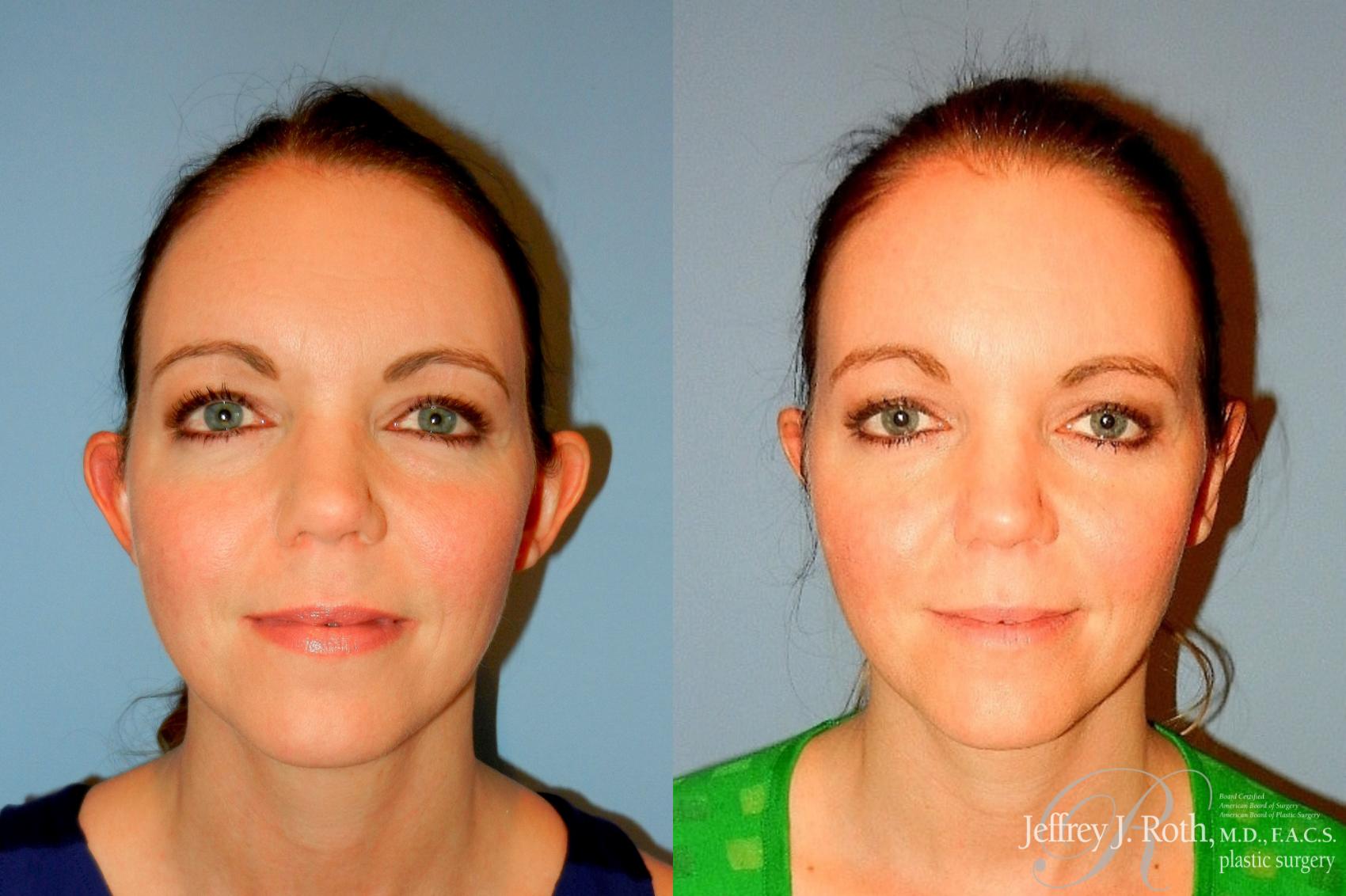 Before & After Otoplasty Case 305 Front View in Las Vegas and Henderson, NV