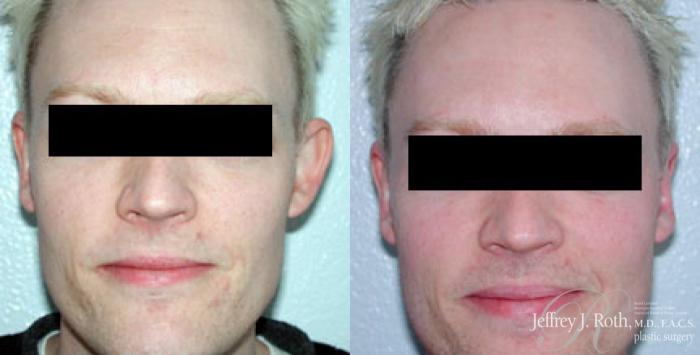 Before & After Otoplasty Case 167 View #1 View in Las Vegas and Henderson, NV