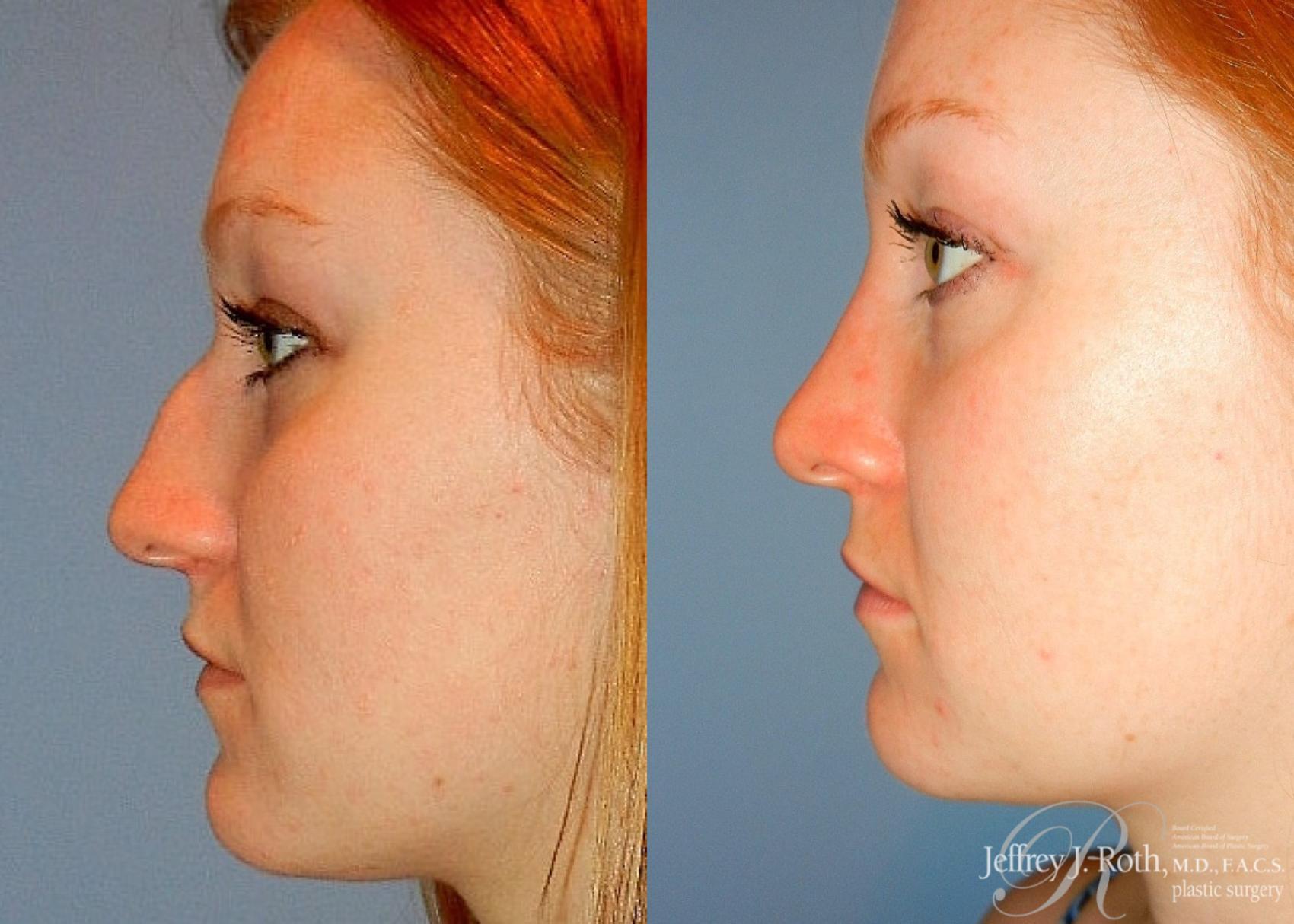 Before & After Rhinoplasty Case 159 View #1 View in Las Vegas and Henderson, NV