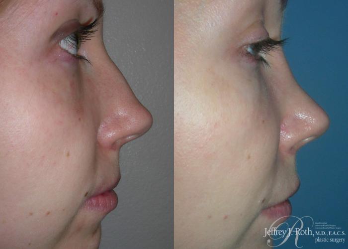 Before & After Rhinoplasty Case 160 View #1 View in Las Vegas and Henderson, NV