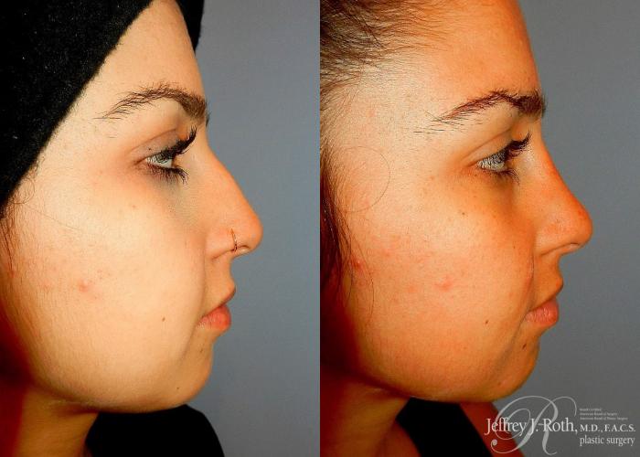 Before & After Rhinoplasty Case 161 View #1 View in Las Vegas and Henderson, NV