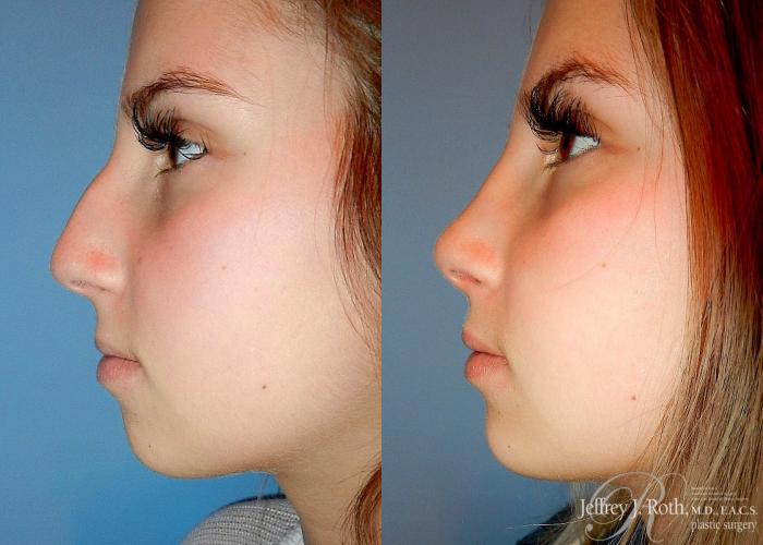 Before & After Rhinoplasty Case 162 View #1 View in Las Vegas and Henderson, NV