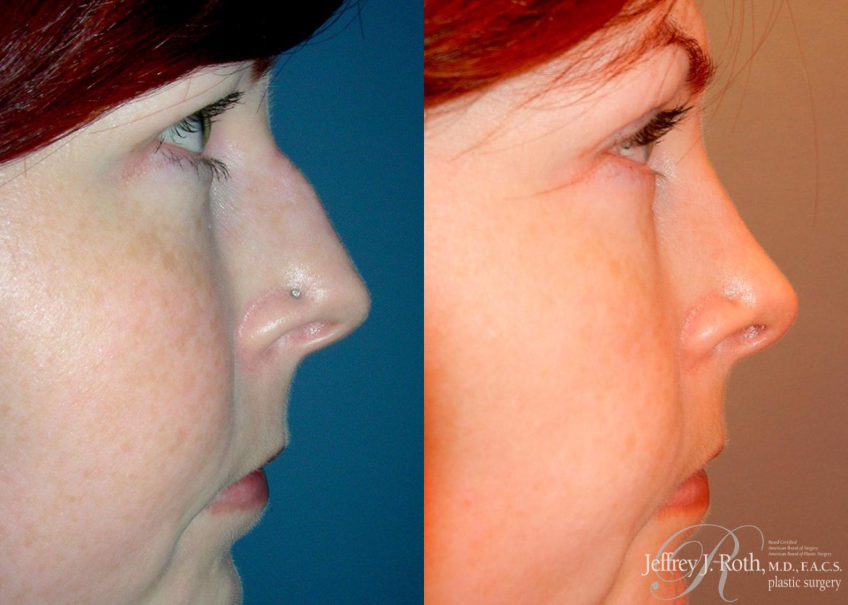 Before & After Rhinoplasty Case 163 View #1 View in Las Vegas and Henderson, NV