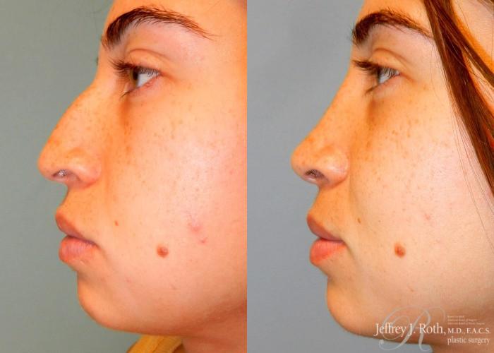 Before & After Rhinoplasty Case 164 View #1 View in Las Vegas and Henderson, NV