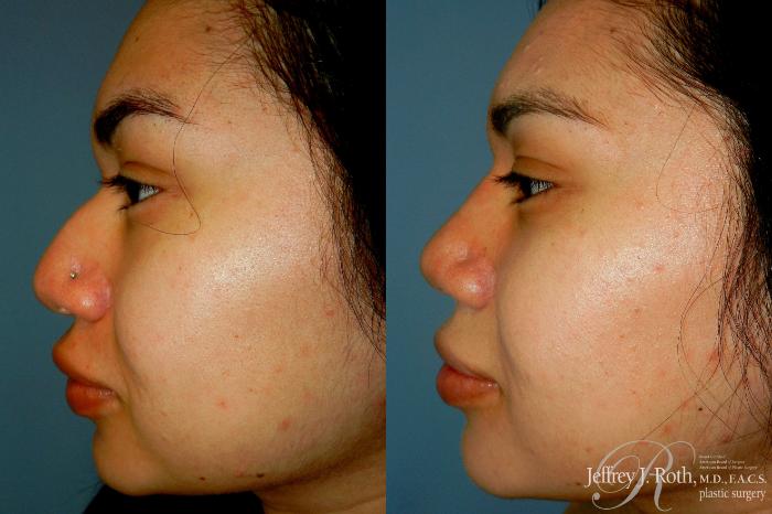 Before & After Rhinoplasty Case 311 Left Side View in Las Vegas and Henderson, NV