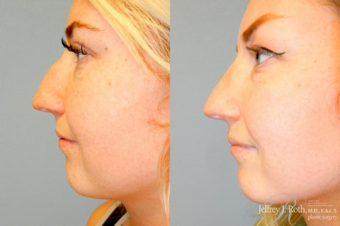 Before & After Rhinoplasty Case 329 Left Side View in Las Vegas and Henderson, NV