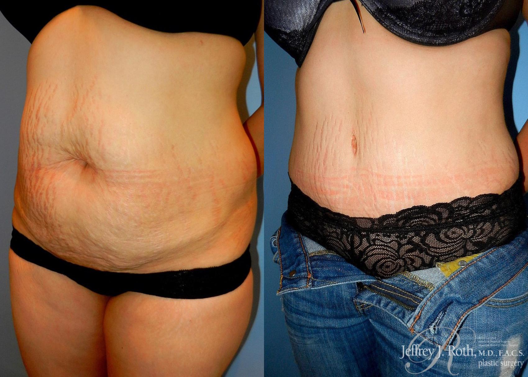 Before & After Tummy Tuck Case 24 View #2 View in Las Vegas, NV