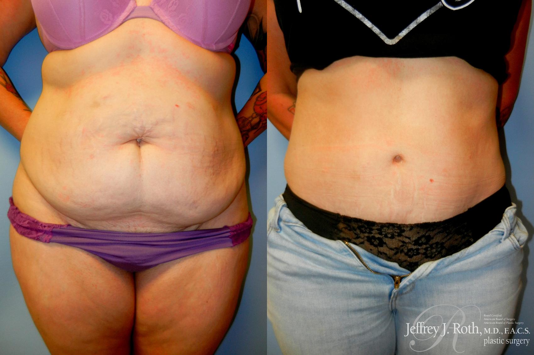 Before & After Tummy Tuck Case 279 Front View in Las Vegas and Henderson, NV