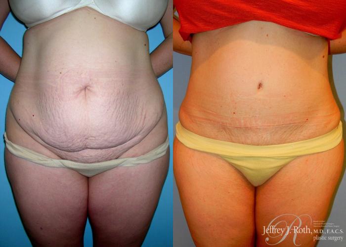 Before & After Tummy Tuck Case 28 View #1 View in Las Vegas and Henderson, NV