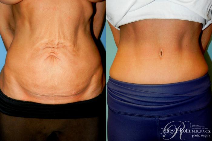 Before & After Tummy Tuck Case 309 Front View in Las Vegas and Henderson, NV
