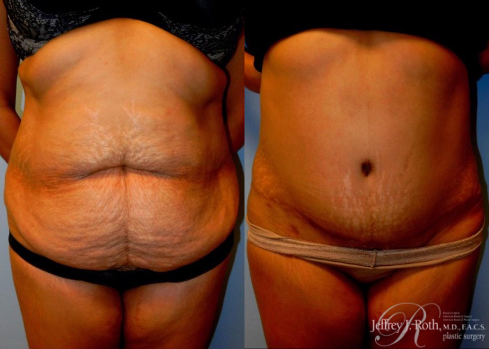 Before & After Tummy Tuck Case 34 View #1 View in Las Vegas and Henderson, NV