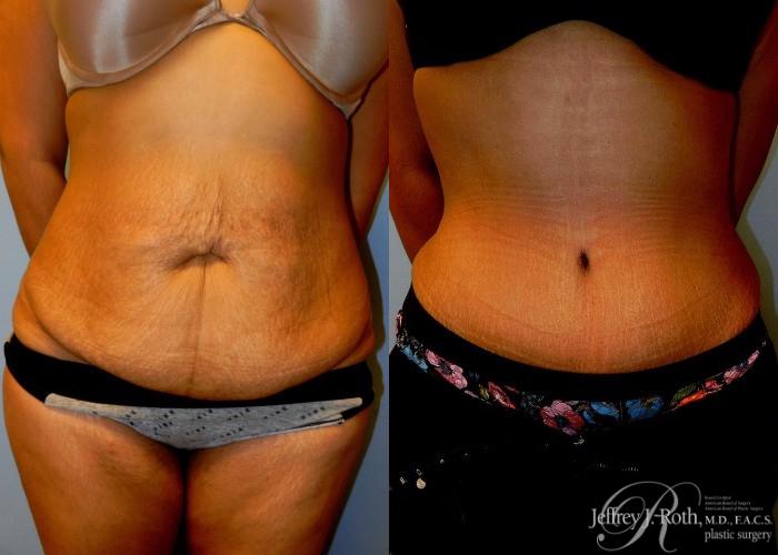 Before & After Tummy Tuck Case 35 View #1 View in Las Vegas and Henderson, NV